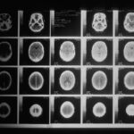 Troubles neurologiques fonctionnels: quand le cerveau perd les repères de la réalité-Troublesneurologiques-Fonctionnementducerveau-Repèresdelaréalité-Troublesfonctionnels-Neurologie-Santémentale-Perceptiondelaréalité-Trou