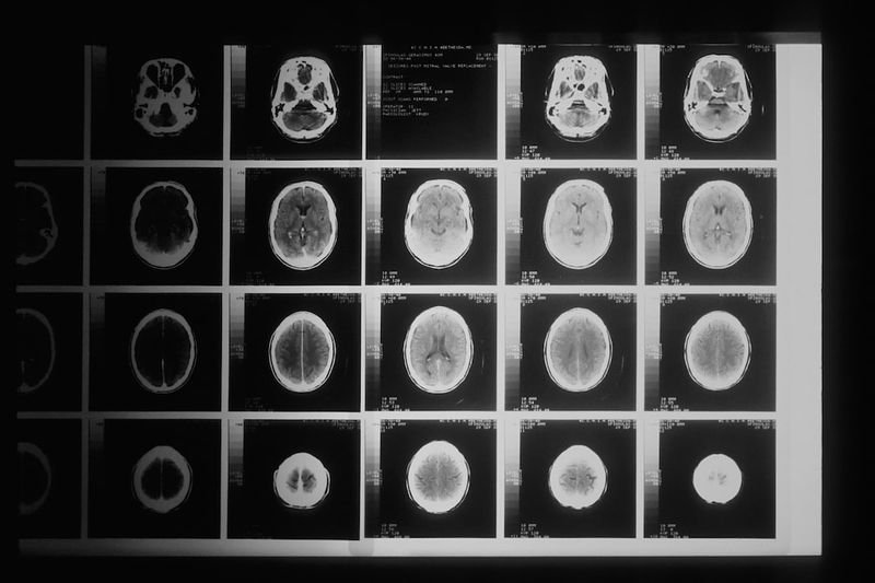 Troubles neurologiques fonctionnels: quand le cerveau perd les repères de la réalité-Troublesneurologiques-Fonctionnementducerveau-Repèresdelaréalité-Troublesfonctionnels-Neurologie-Santémentale-Perceptiondelaréalité-Trou